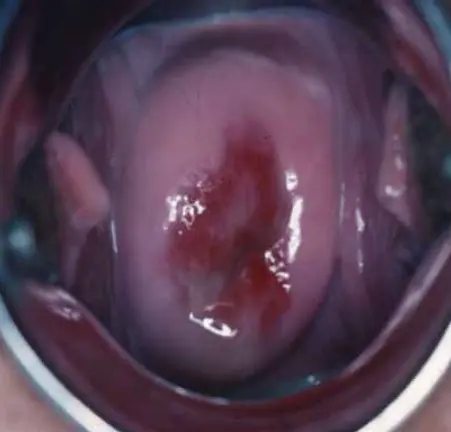 White discharge adhering to the vaginal walls